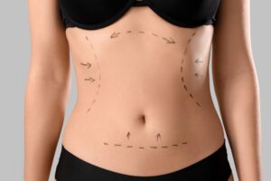Abdominoplastia no Jardim Paulista, SP