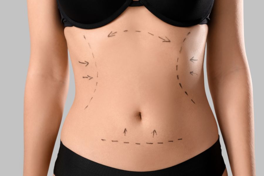 Abdominoplastia no Jardim Paulista, SP